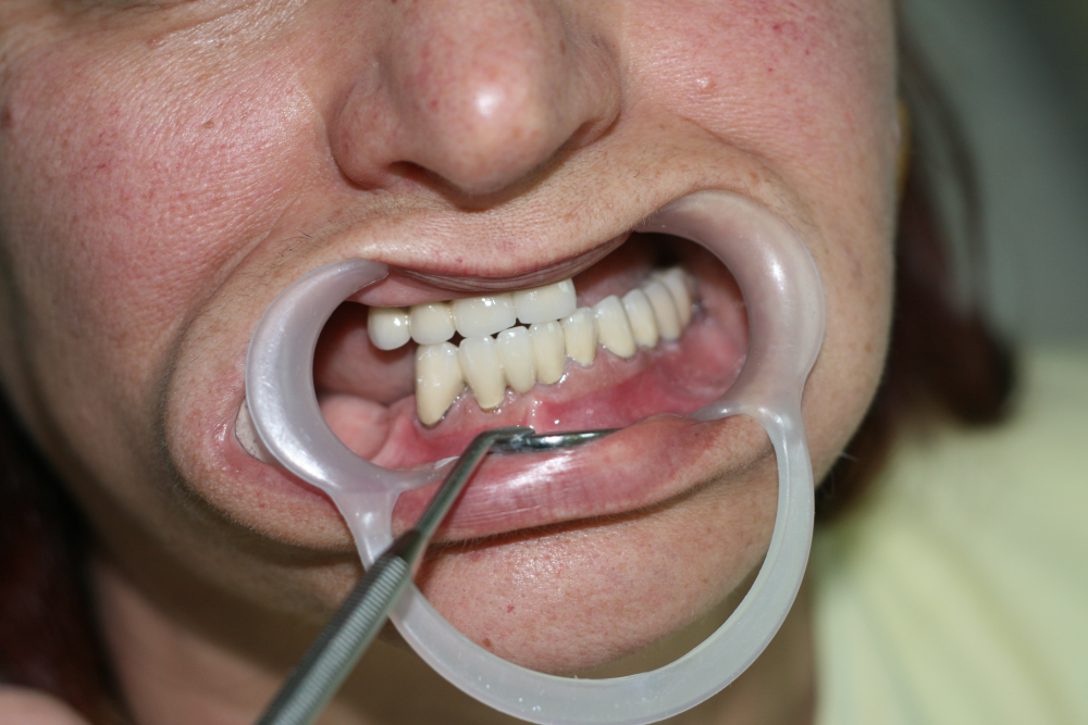 Зъбите в централна оклузия