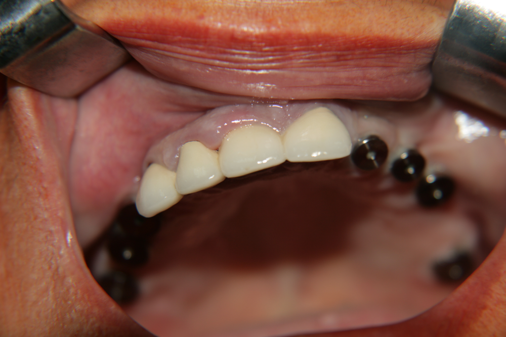 Имплантати и естествени зъби