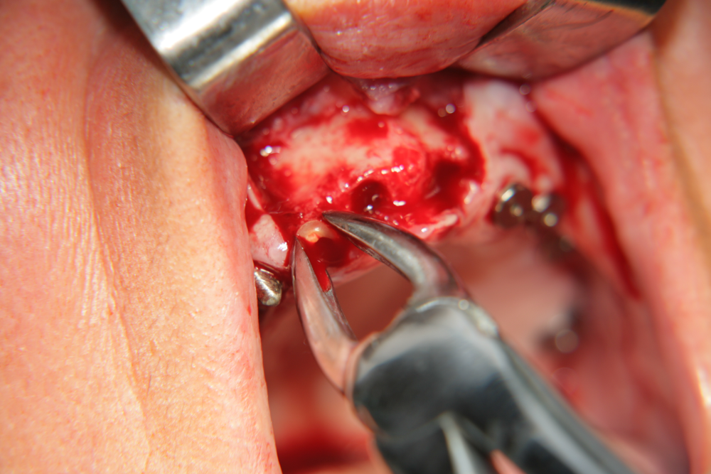 Зъбна екстракция