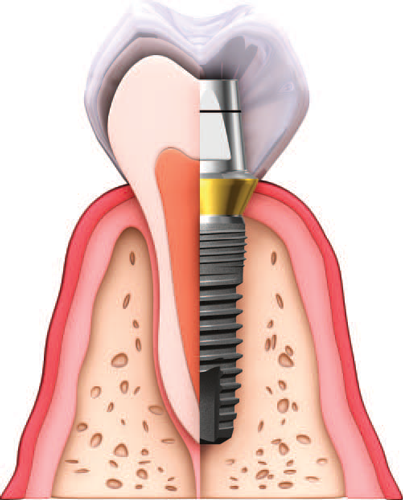 Имплант и зъб
