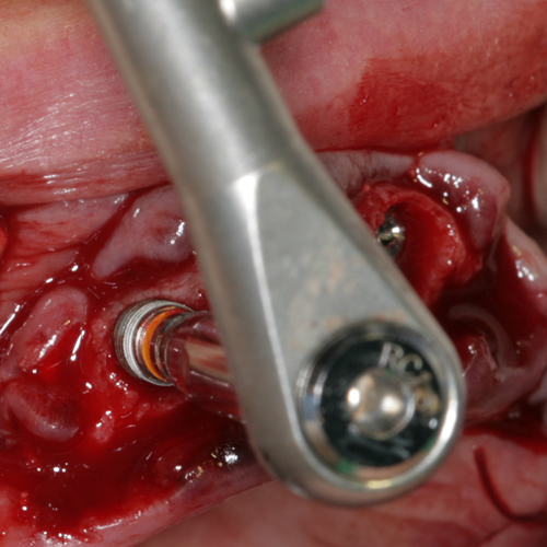 Поставяне на зъбен имплант