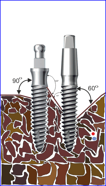 Схема на костната резорбция около имплантите