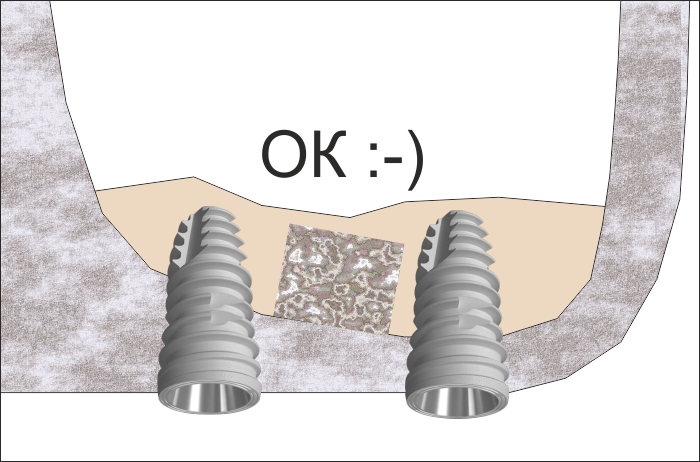 Зъбни импланти и костен блок - първична стабилност