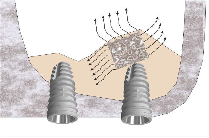 Зъбни импланти и костен блок - лоша първична стабилност