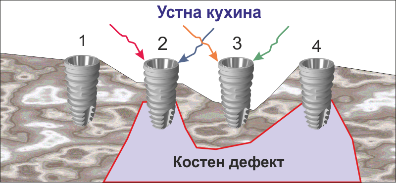 Зъбни импланти - първична стабилност