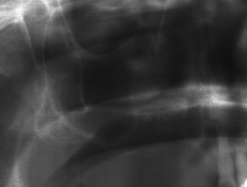 Рентгенография преди повдигане на синуса